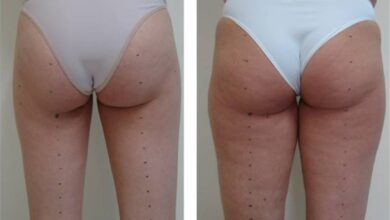 Photo of Асимметрия ягодиц, ягодичных складок у женщин