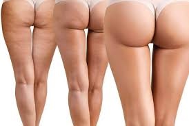 Photo of Асимметрия ягодиц, ягодичных складок у женщин